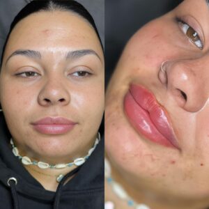 Lip Filler Masterclass - Full day (10:00hrs to 16:30hrs) + Pre Study